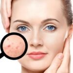 What is the best acne clear treatment?