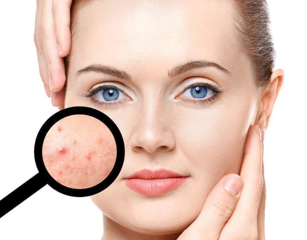 What is the best acne clear treatment?