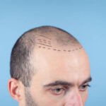 Hair Transplant in Karachi: Costs, Benefits, and Top Clinics