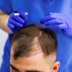 BEST SURGEON FOR HAIR TRANSPLANT IN ISLAMABAD PAKISTAN