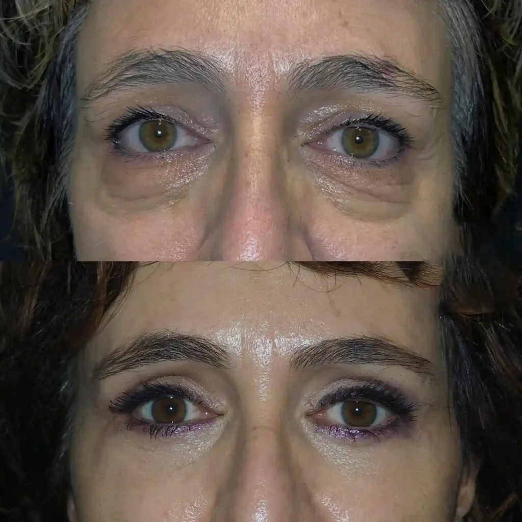 Eye Bag Removal